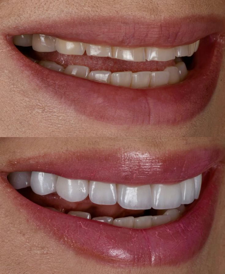 Dental Implant Treatment