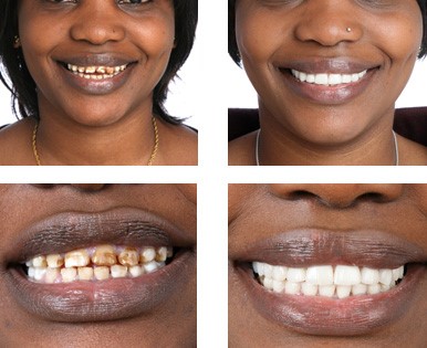 Smile transformation