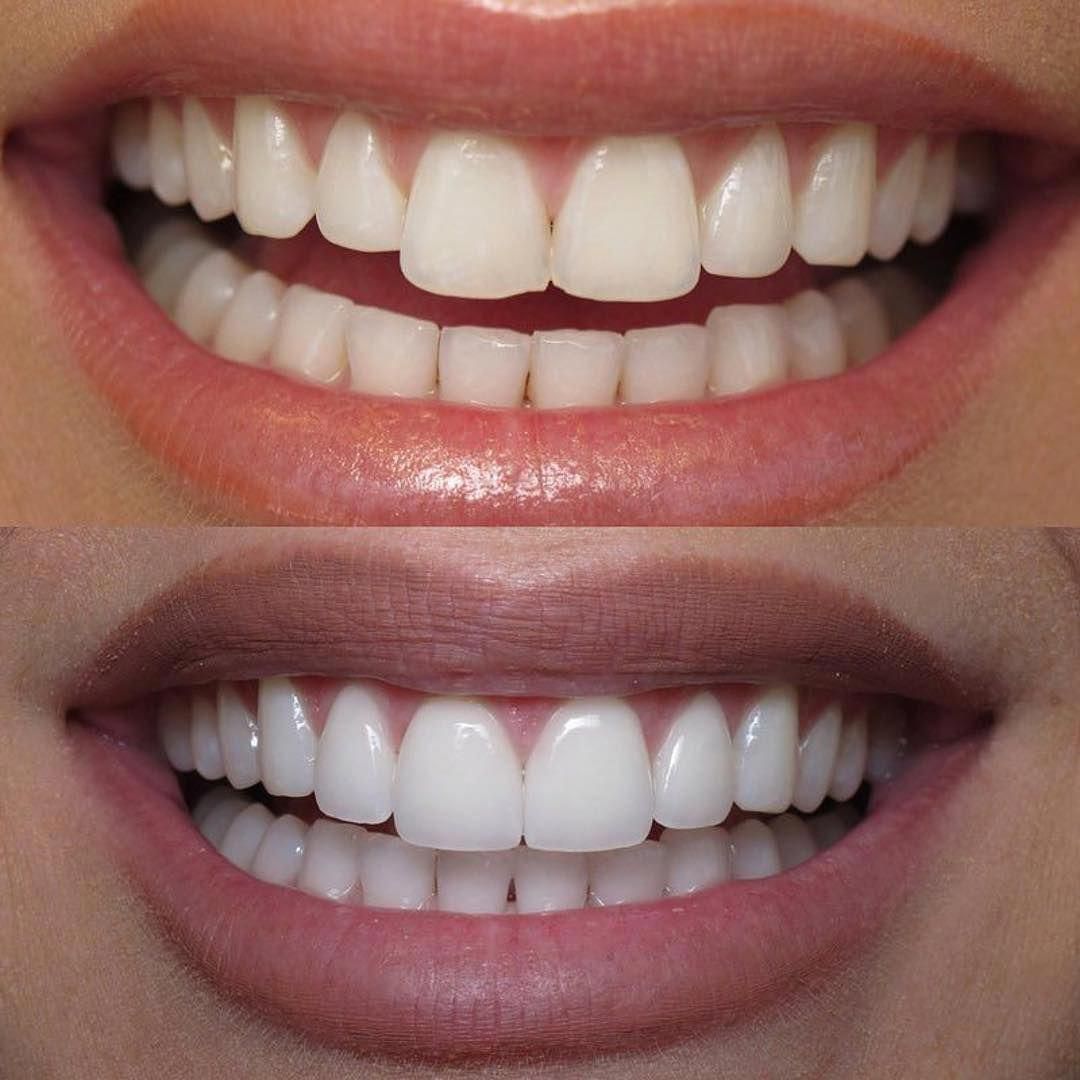 Teeth Whitening Treatment