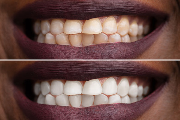 Teeth whitening results